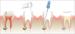 http://www.clearchoicedentalgroup.com/wp-content/uploads/2014/09/root-canal.jpg